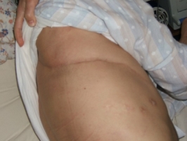 Dr. Saeed Behshid's surgical scars November 16, 2006